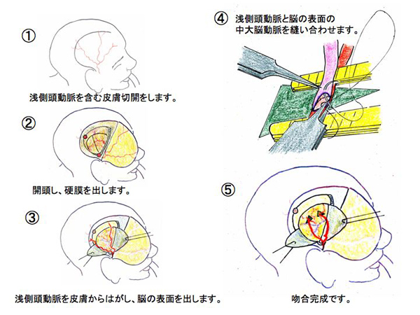 もやもや病 | KOMPAS – 慶應義塾大学病院 医療・健康情報サイト