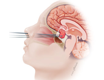 内視鏡的経蝶形骨洞下垂体手術施行患者における吸入麻酔と TIVA の回復