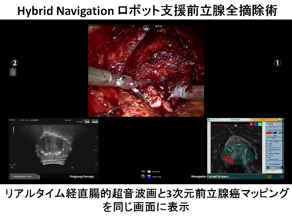 Hybrid Navigationを用いたロボット支援前立腺全摘除術 | 京都府立医科