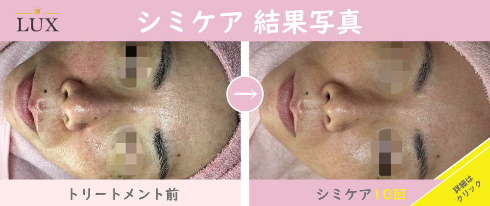 口コミで人気の天王寺シミケアエステサロンMENU ｜シミ専門エステLUX天王寺