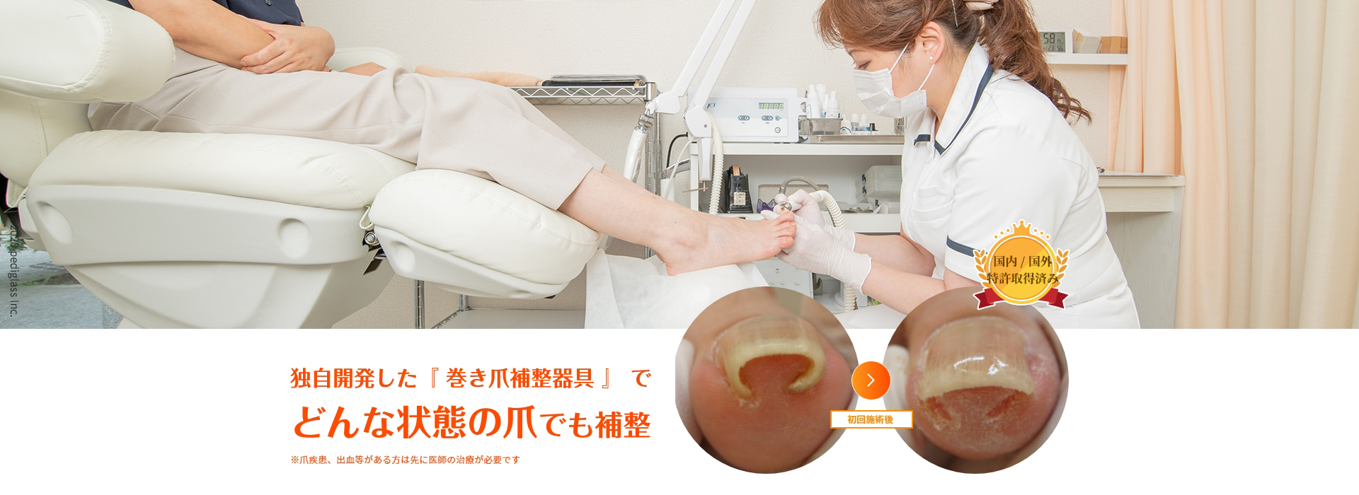 痛くない巻き爪補正 初日で痛みが取れる｜大阪市淀川区｜ペディグラス