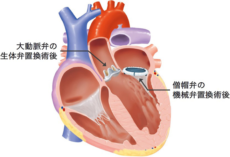 心臓弁膜症の治療 – 医療法人恵山会 丸山病院