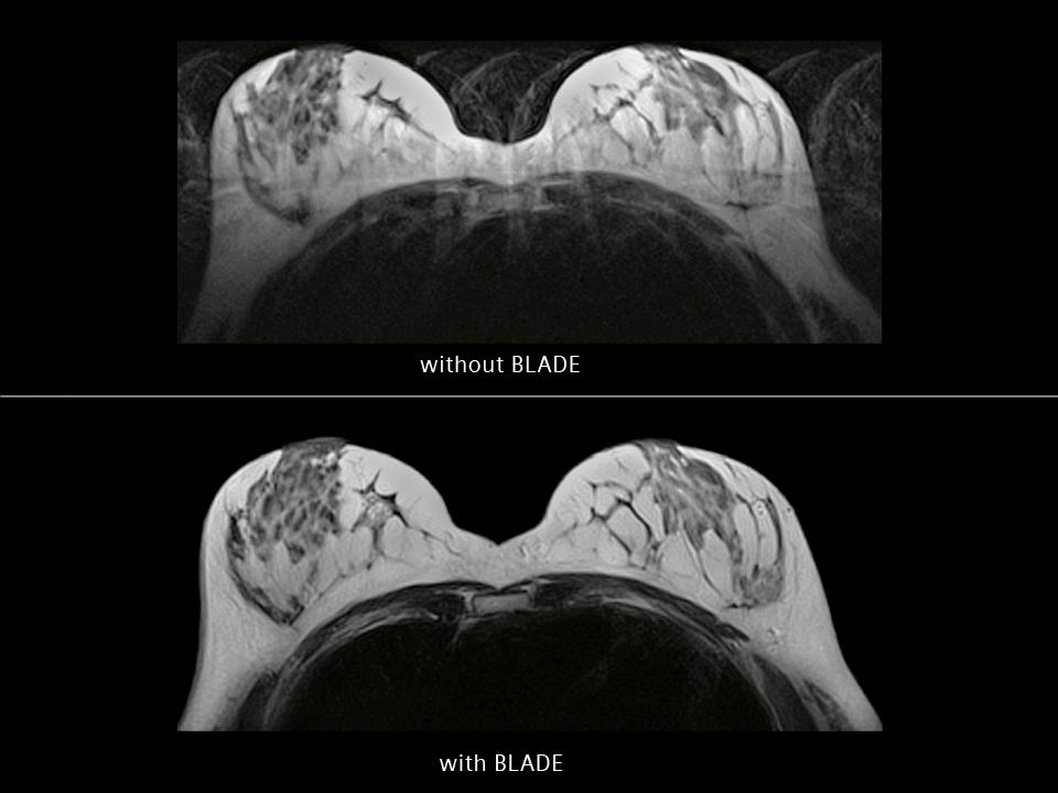 Breast MRI - Siemens Healthineers USA