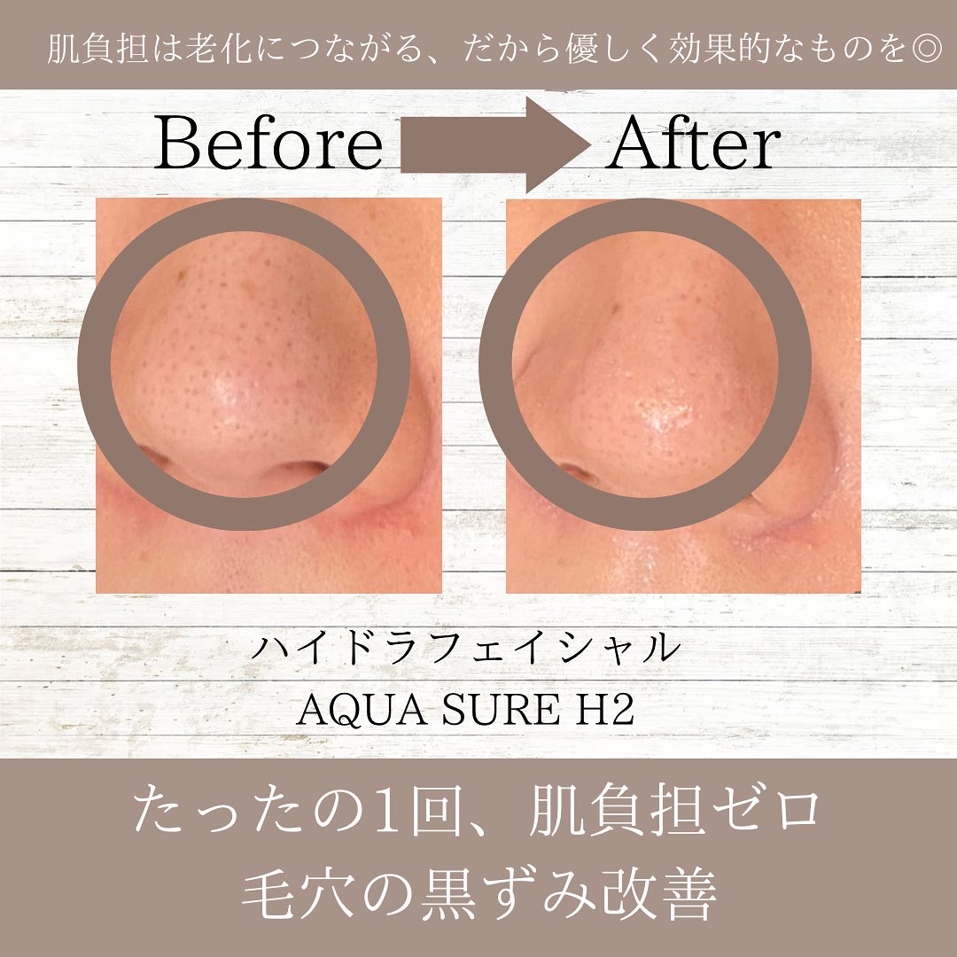 柏駅】ハイドラフェイシャルAQUA SURE H2▶︎▶︎『肌に負担をかけない