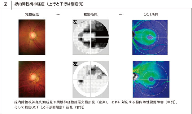 緑内障：日経メディカル