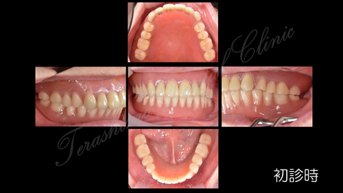 インプラントの総合治療~全ての歯がインプラントです~ | 箕面市の