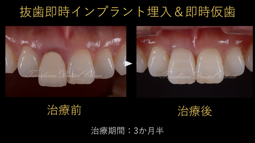 前歯の審美インプラント 外傷による歯根破折のケース 44歳女性 | 箕面