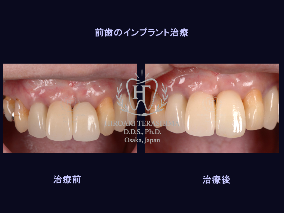 前歯のインプラント治療～シンプルな治療～ | 箕面市の歯医者【寺嶋