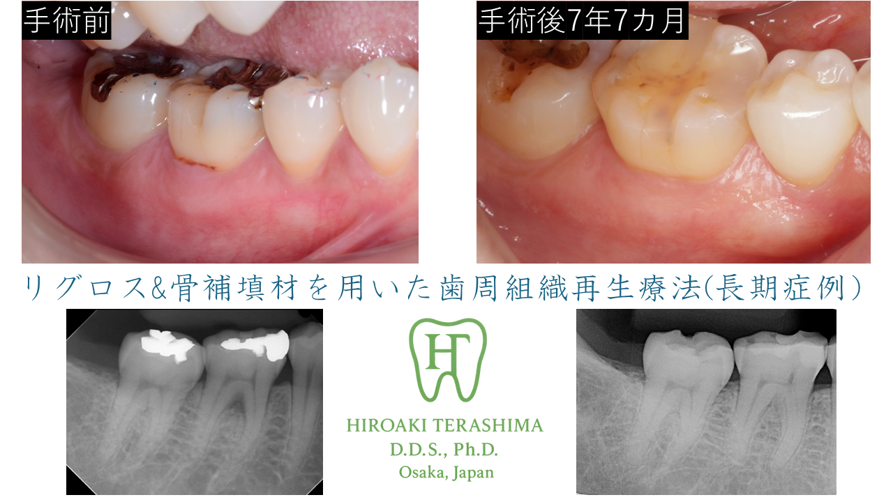 リグロス黎明期に行った歯周組織再生療法の長期経過症例（右下6番 分岐