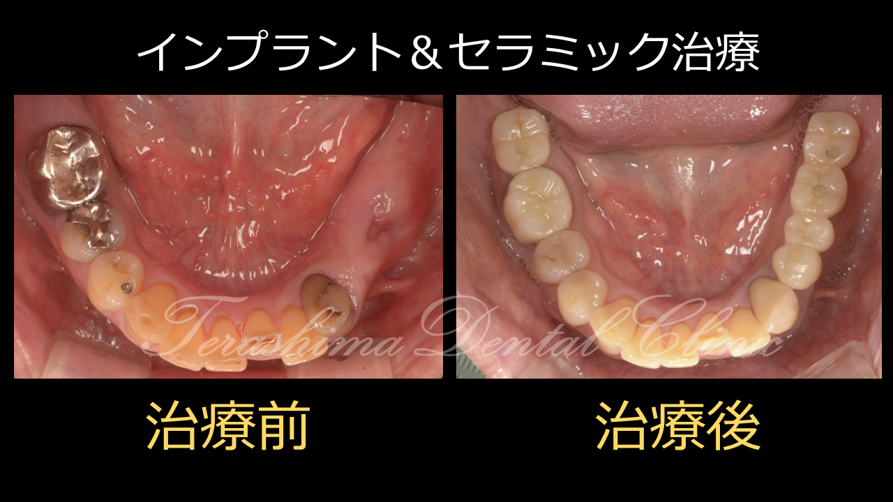シンプルなインプラントとセラミックの複合治療～60代男性～ | 箕面市