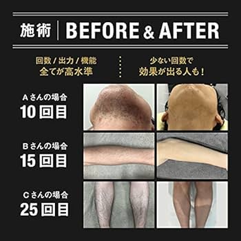 Amazon | MCLEAR メンズクリア ホームクリア 脱毛器 メンズ 限定特典