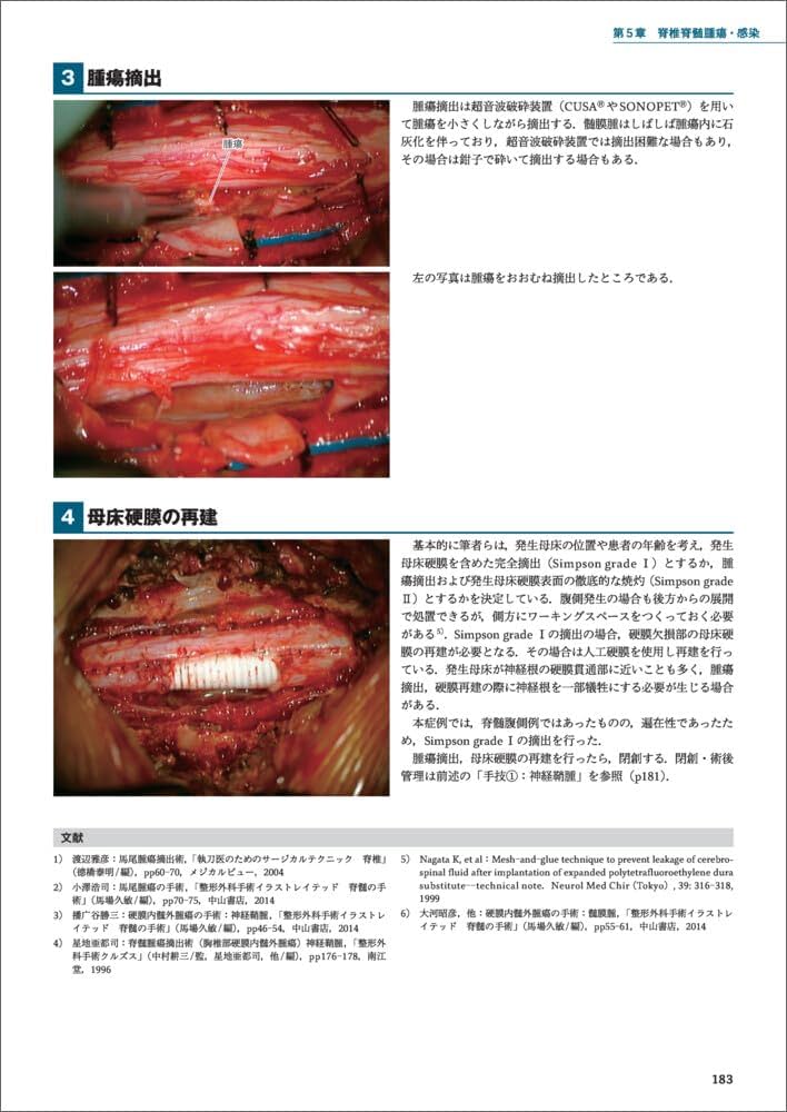 脊椎手術パーフェクト〜術前準備から展開、除圧、固定、閉創まで術中