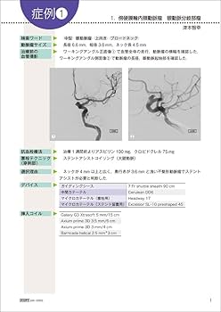 未破裂脳動脈瘤コイル塞栓術100のテクニック | 大石 英則 |本 | 通販
