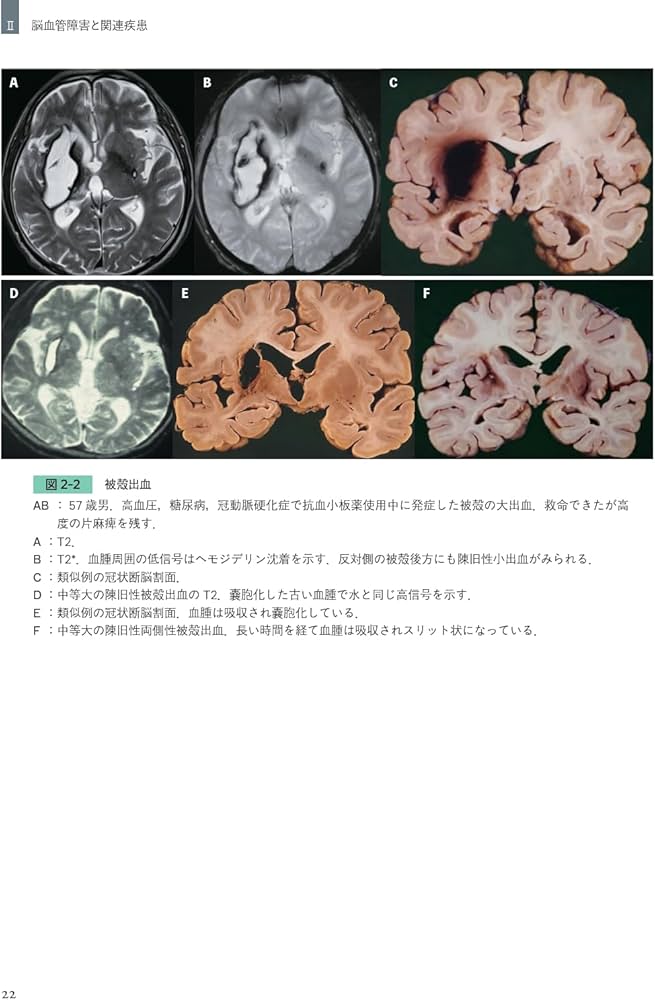 同一症例の経過・画像・病理で紐解く 臨床神経病理ワールド | 宇高不可