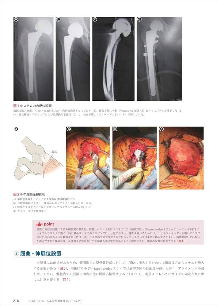 BHA・THA 人工股関節置換術パーフェクト〜人工骨頭置換術・人工股関節