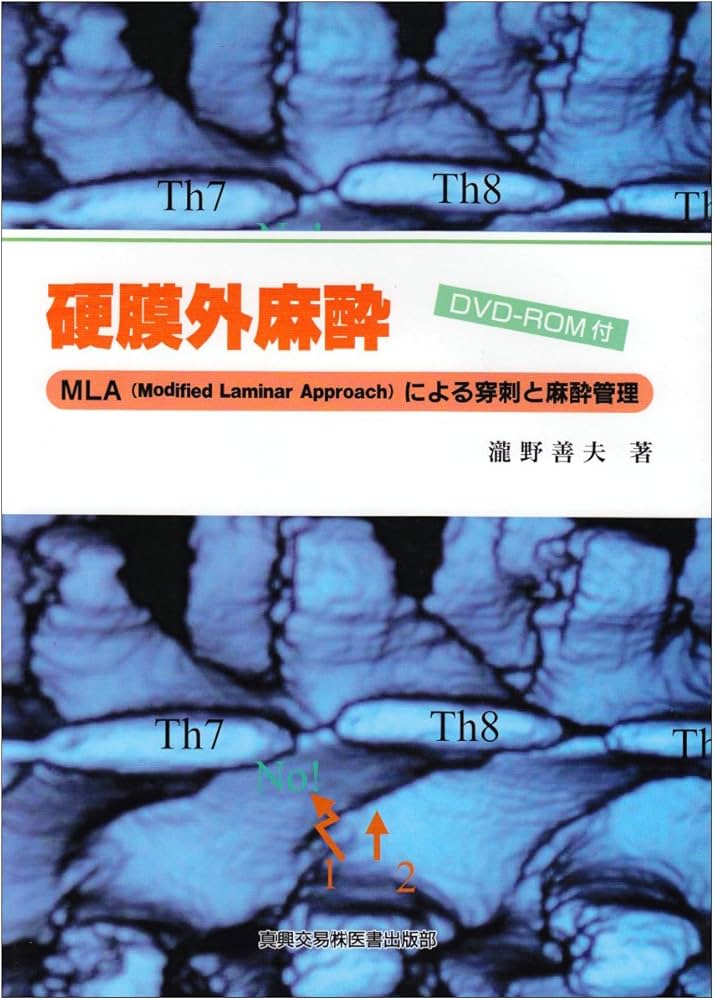 Amazon.co.jp: 硬膜外麻酔: MLA(modified laminar approach)による穿刺