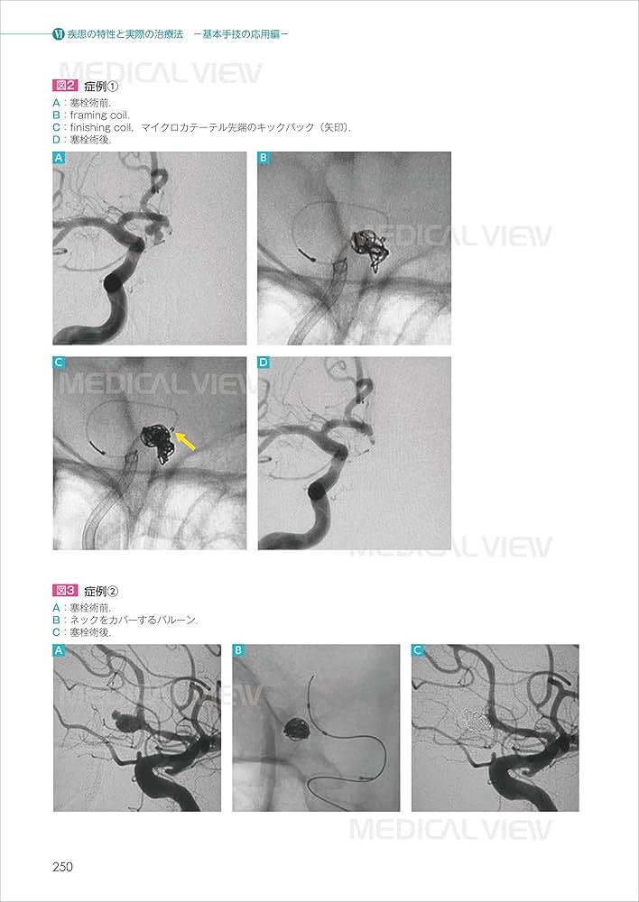パーフェクトマスター脳血管内治療−第3版 | 滝 和郎, 中原 一郎, 太田
