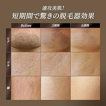 Amazon | 2025年【忙しいあなたの朝にゆとりを。】 BLACKRAVE 脱毛器