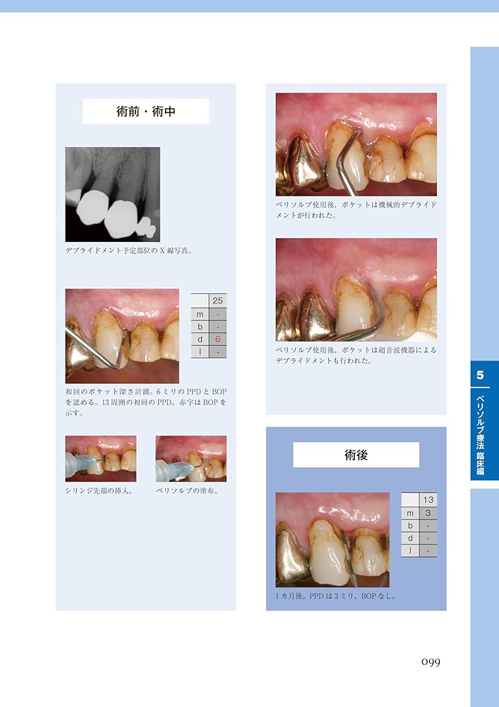 カリソルブ療法とペリソルブ療法の基礎と臨床、応用まで: スウェーデン