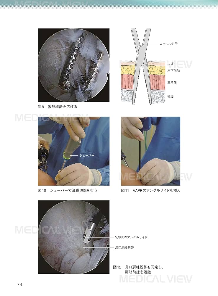 肩の鏡視下手術 改訂第2版 (ゼロからマスター) | 中川 照彦 |本 | 通販