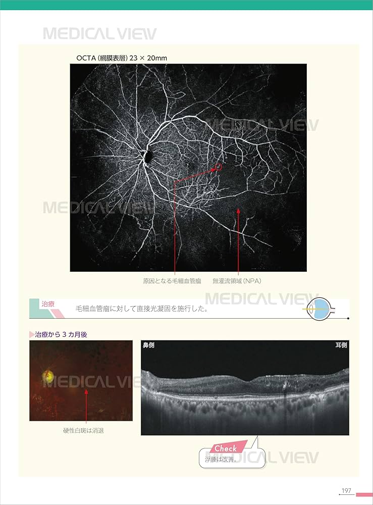 新OCT・OCTA読影トレーニング−改訂第2版 | 飯田 知弘, 森實 祐基