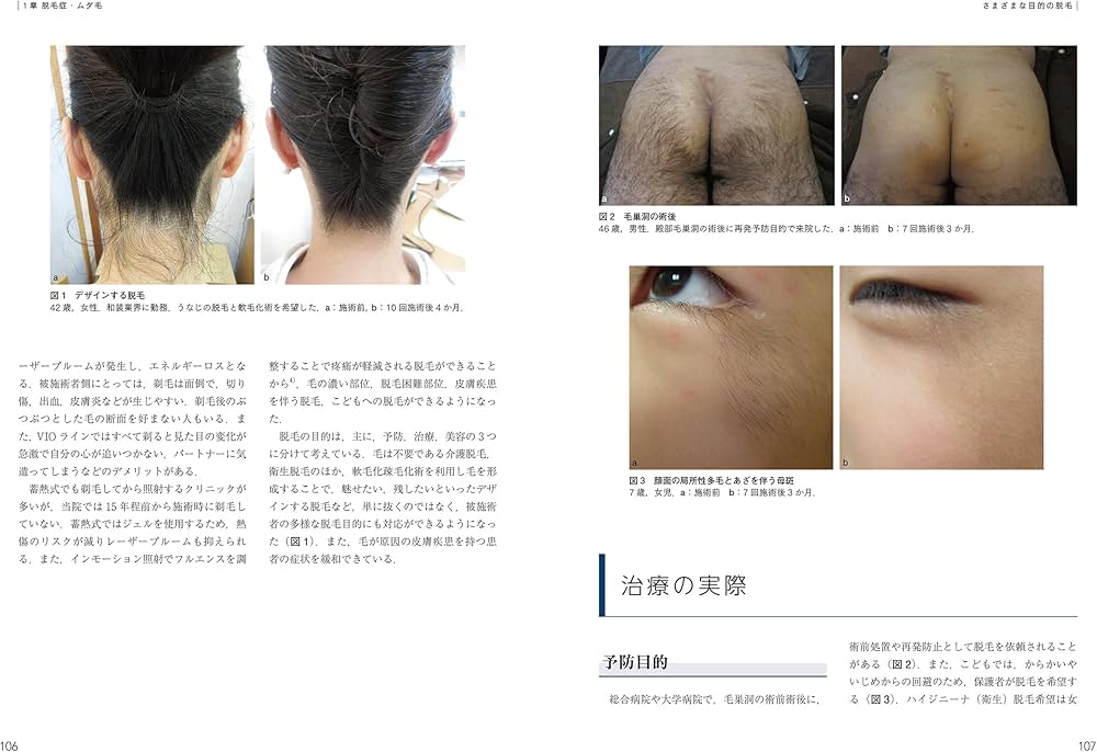 脱毛・にきびの治療ー美容皮膚科オールラウンド (最新美容皮膚科学大系