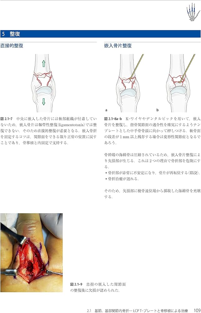 Amazon.co.jp: AO法骨折治療 Hand (AOTRAUMA) : 田中 正: 本