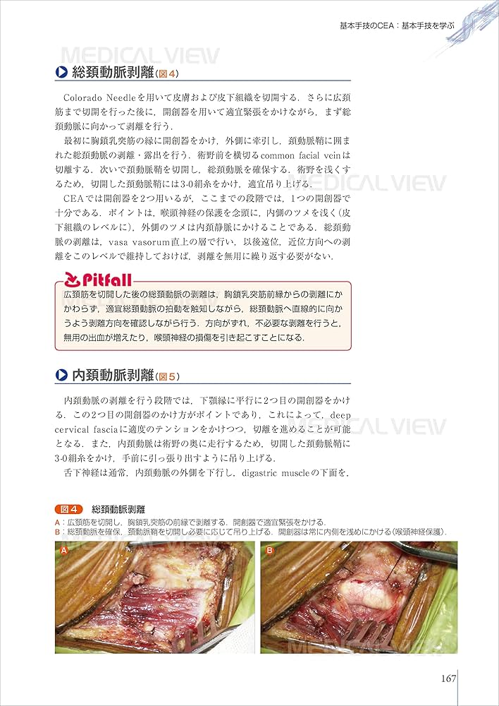 パーフェクトマスター 頚動脈狭窄症 | 永田 泉, 中原 一郎 |本 | 通販