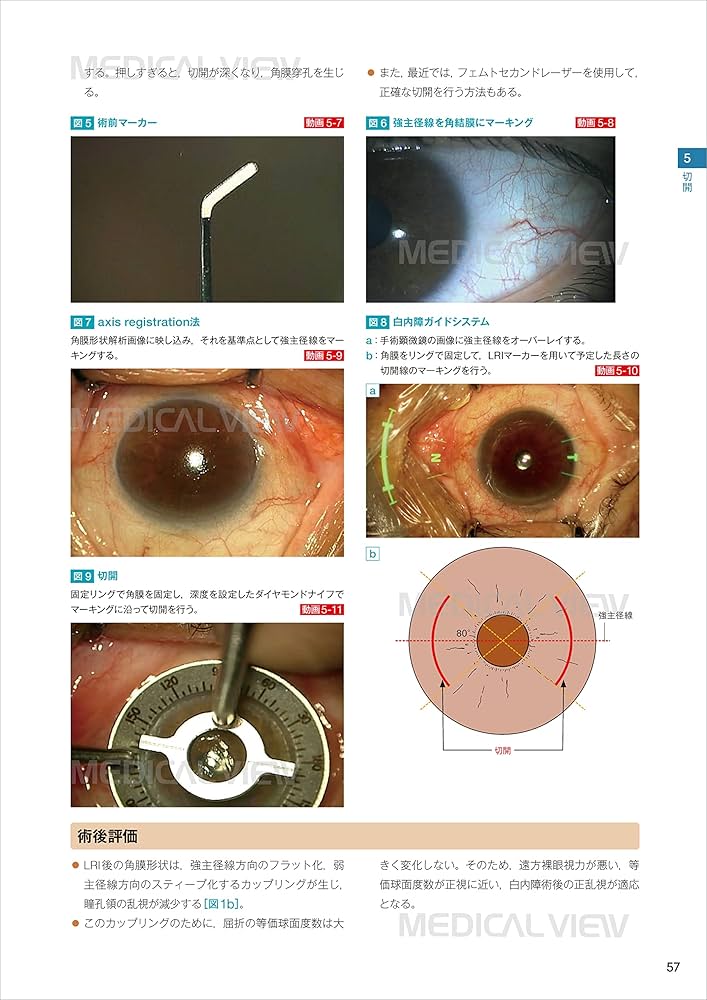スタンダード白内障手術［Web動画付］ | 宮田 和典, 神谷 和孝, 大鹿