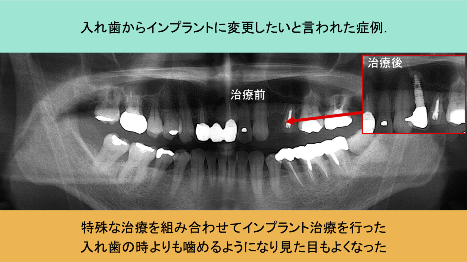 咬み合わせ治療症例（インプラント） | 大津市の歯医者なら「宮谷歯科