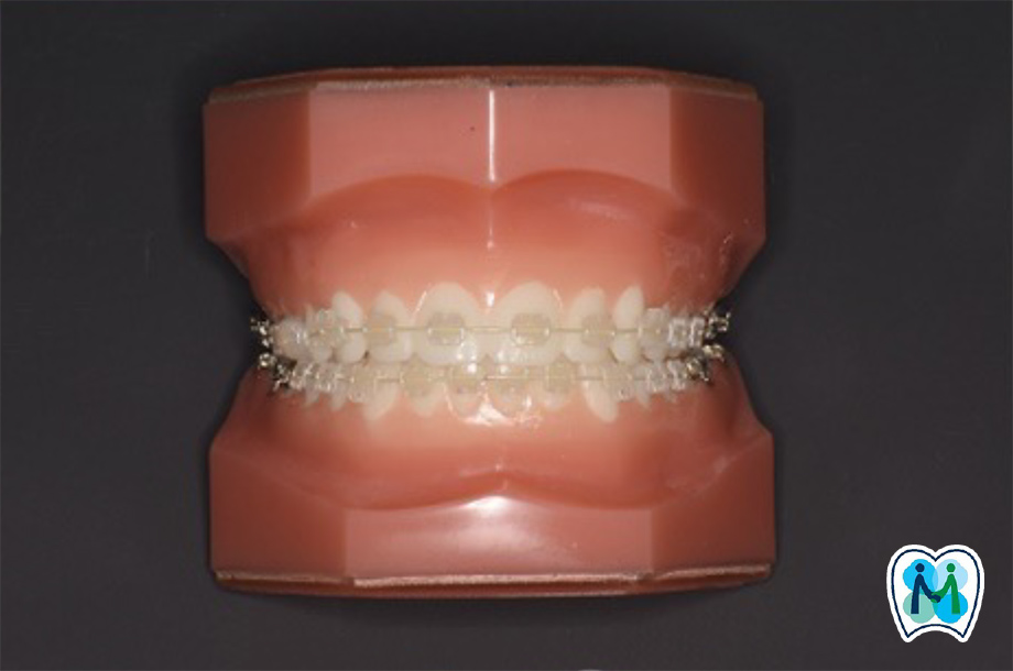 表側矯正・MFT（口腔筋機能療法）・外科的矯正｜見えにくい装置で矯正