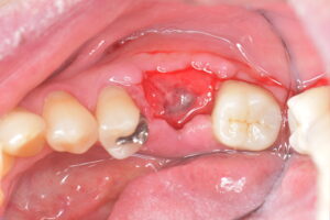 裁断済み】オープンバリアメンブレンテクニック 有限会社 医学情報社