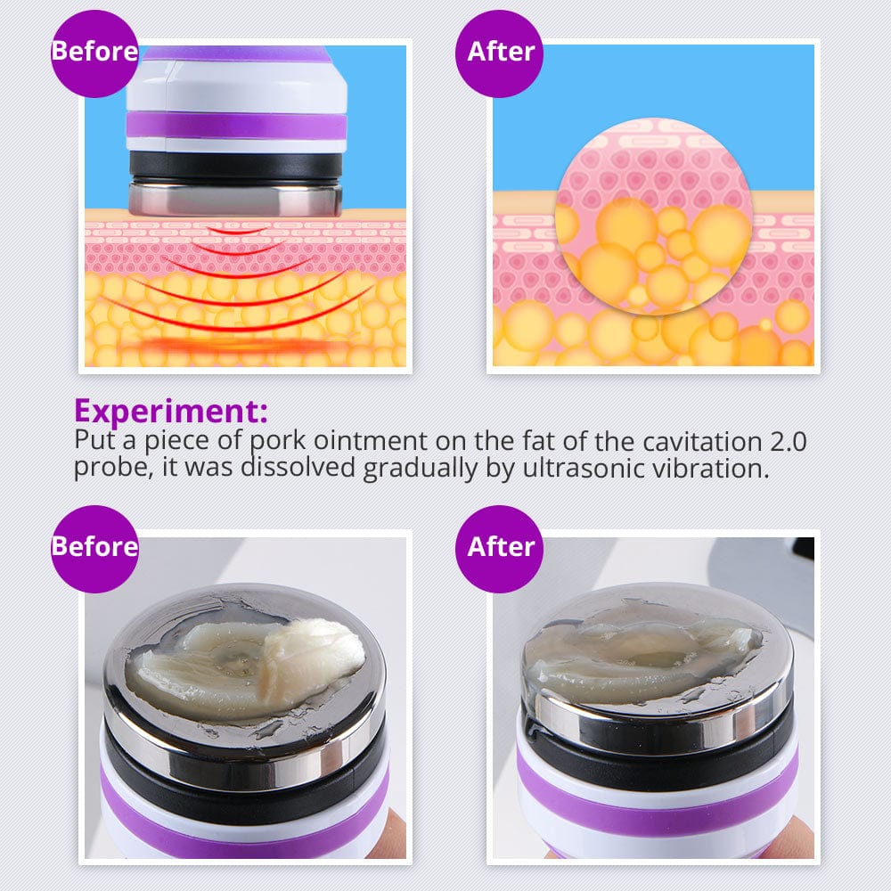 40K Cavitation RF Vacuum Body Sculpting Machine - 5-in-1 Fat Removal