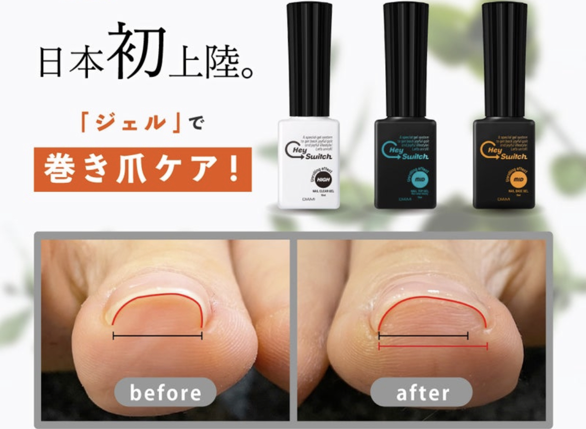 巻き爪ケア 『Hey！Switch』～before・after～1 – Nail Doux（ネイルドゥ）