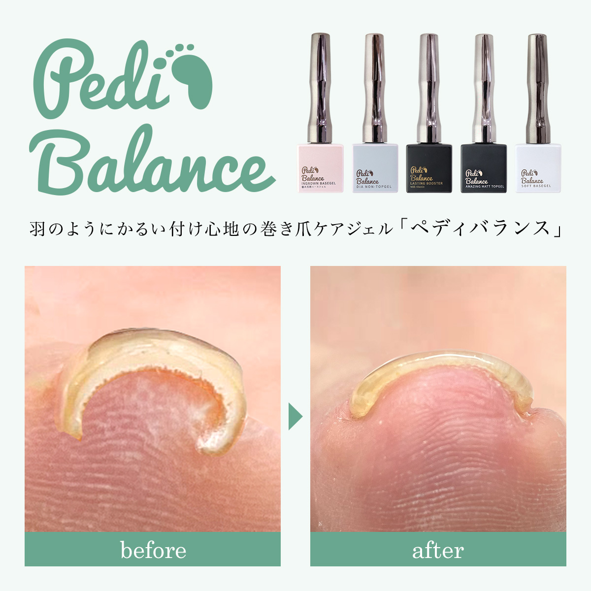 ペディバランス】ジェルを楽しみながら巻き爪ケア♪ | nailsalon