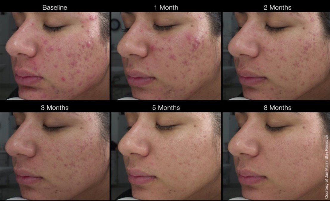 ジャンマリーニ・デュアリティフェイスクリームでニキビ改善