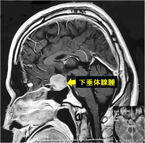 主な検査・手術療法 - 経蝶形骨洞手術