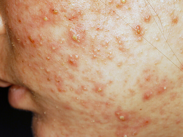 ニキビ・酒さ・乾癬・掌蹠膿疱症・その他疾患 | 新宿区西新宿の皮膚科