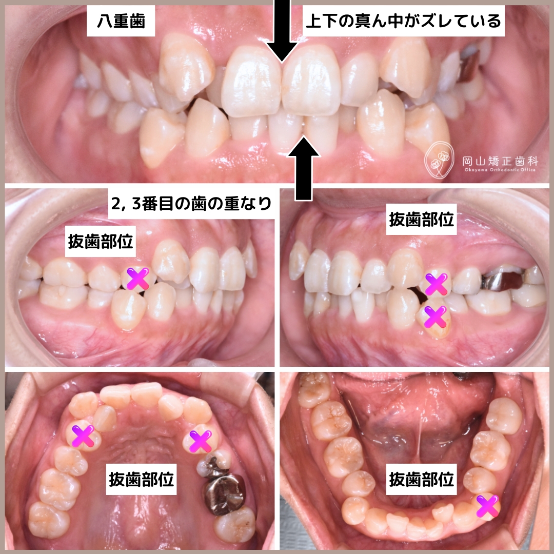 アライナー矯正（マウスピース型矯正装置） | 岡山矯正歯科