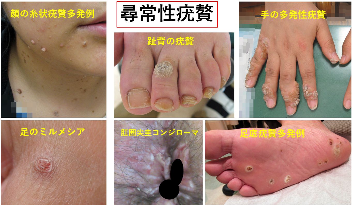 いぼ｜大田区大森・大木皮膚科【尋常性疣贅・イボ治療専門外来】