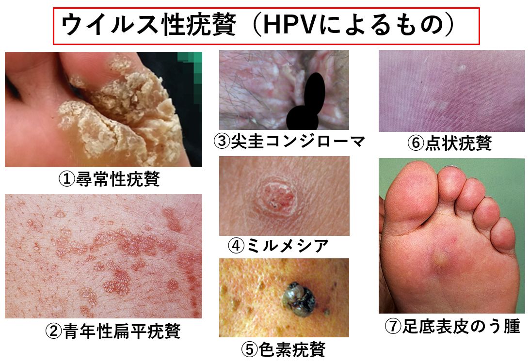 いぼ｜大田区大森・大木皮膚科【尋常性疣贅・イボ治療専門外来】