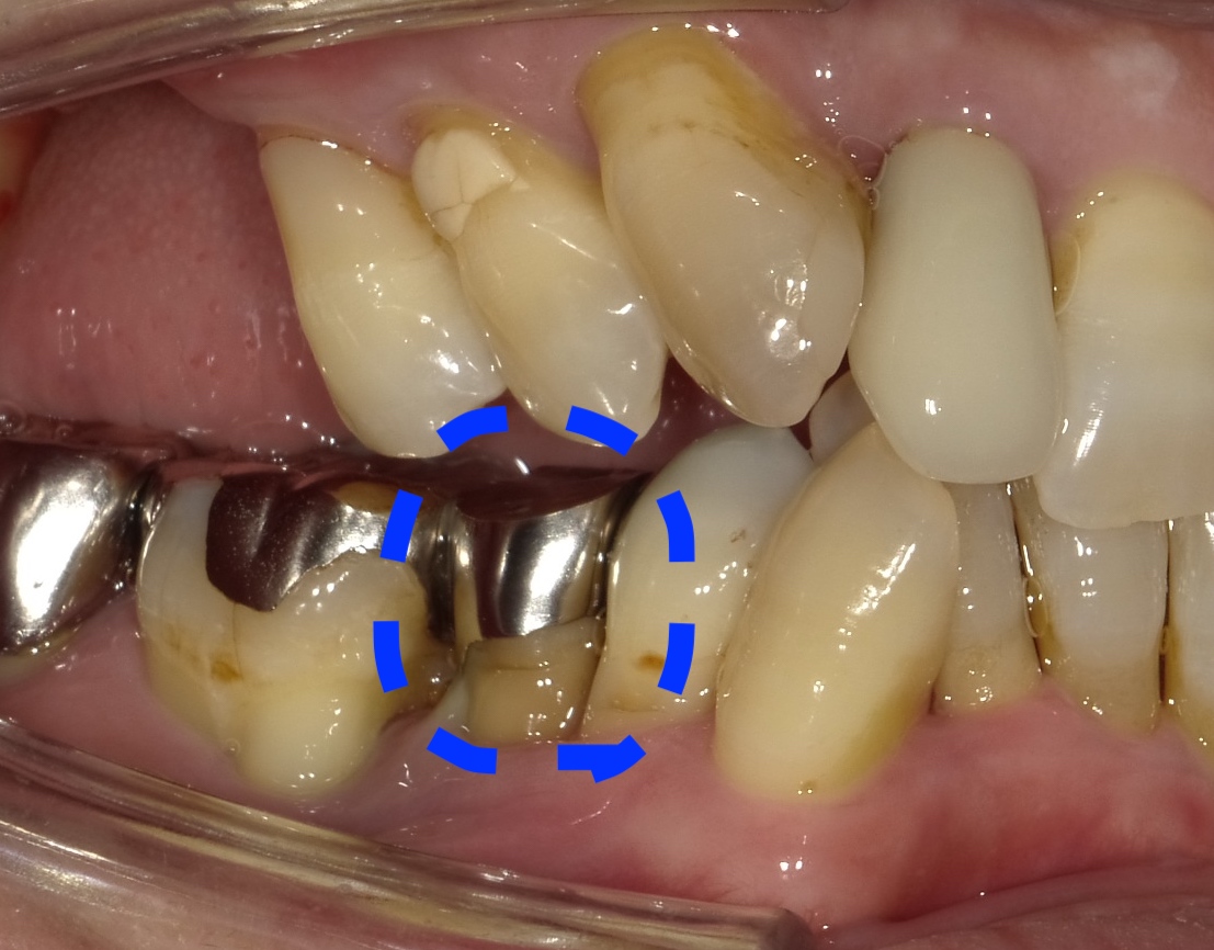 MTM 部分的な矯正治療 アンカースクリューを用いて | 名古屋市北区の
