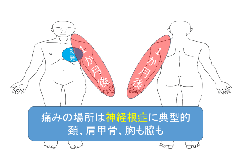 胸痛で発症した頚椎椎間板ヘルニア | 淡海せぼねクリニックブログ