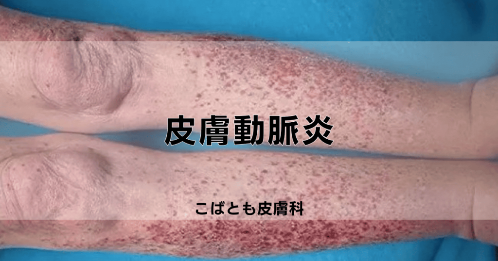 皮膚動脈炎｜こばとも皮膚科｜栄駅（名古屋市栄区）徒歩2分