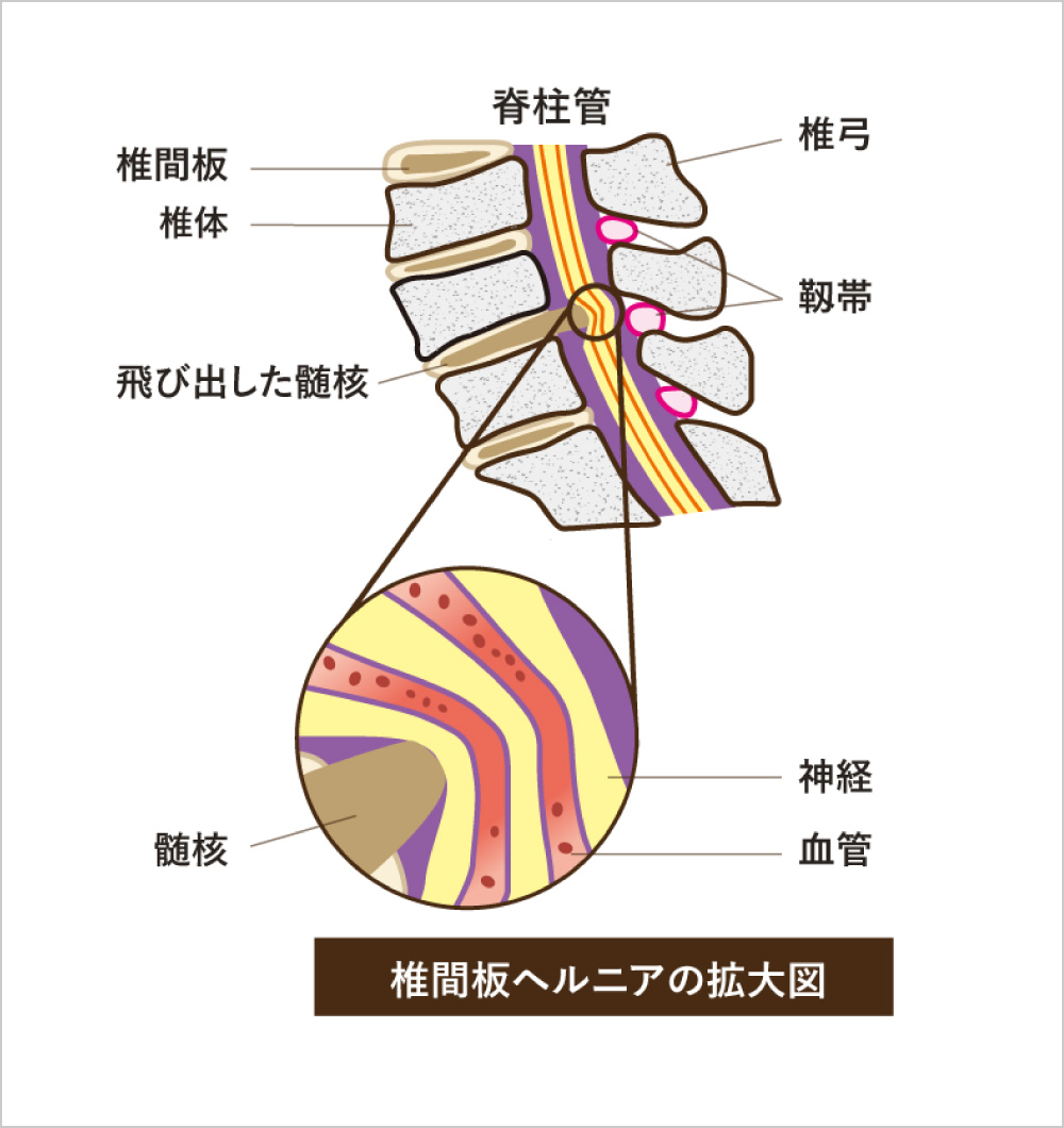 大室整形外科 脊椎・関節クリニック | 脊椎疾患(腰椎) | 脊椎センター