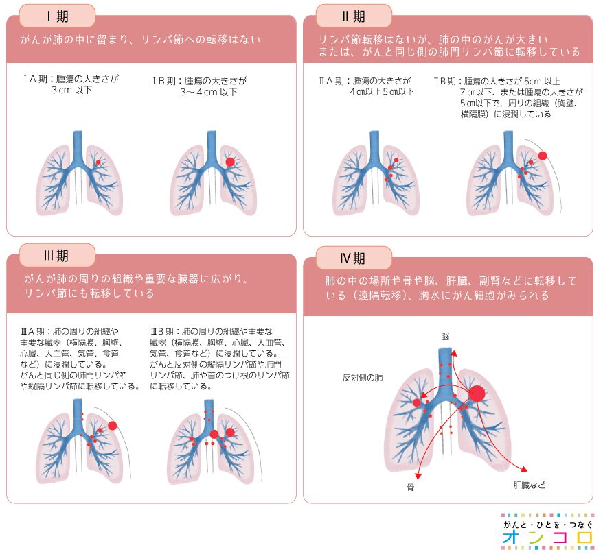 最新の臨床試験結果に基づき専門医が解説する肺がんにおける定位放射線