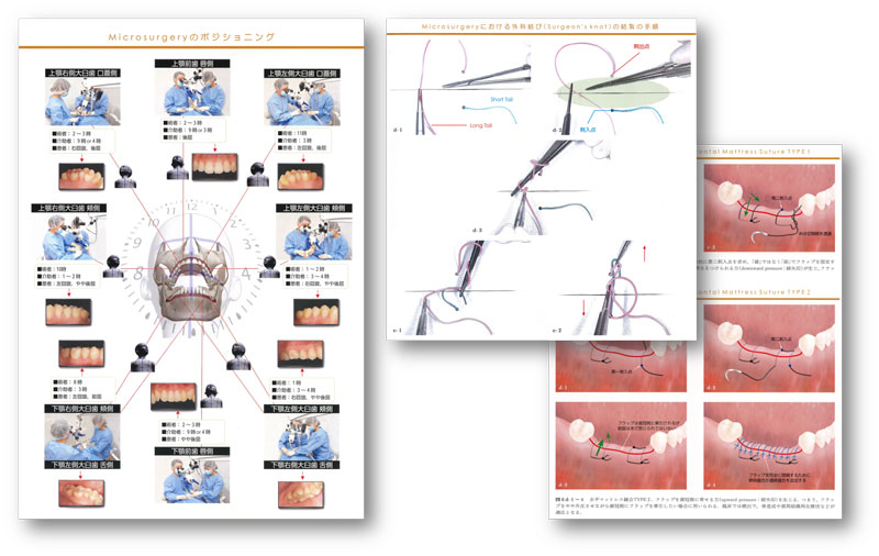 新時代の歯周外科 ー切開と縫合の基本から拡大視野下の手術手技ー