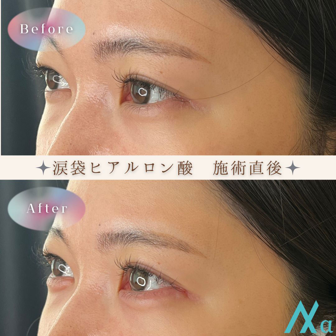 ヒアルロン酸注射の効果と持続期間を徹底解説！効果を長持ちさせる秘訣