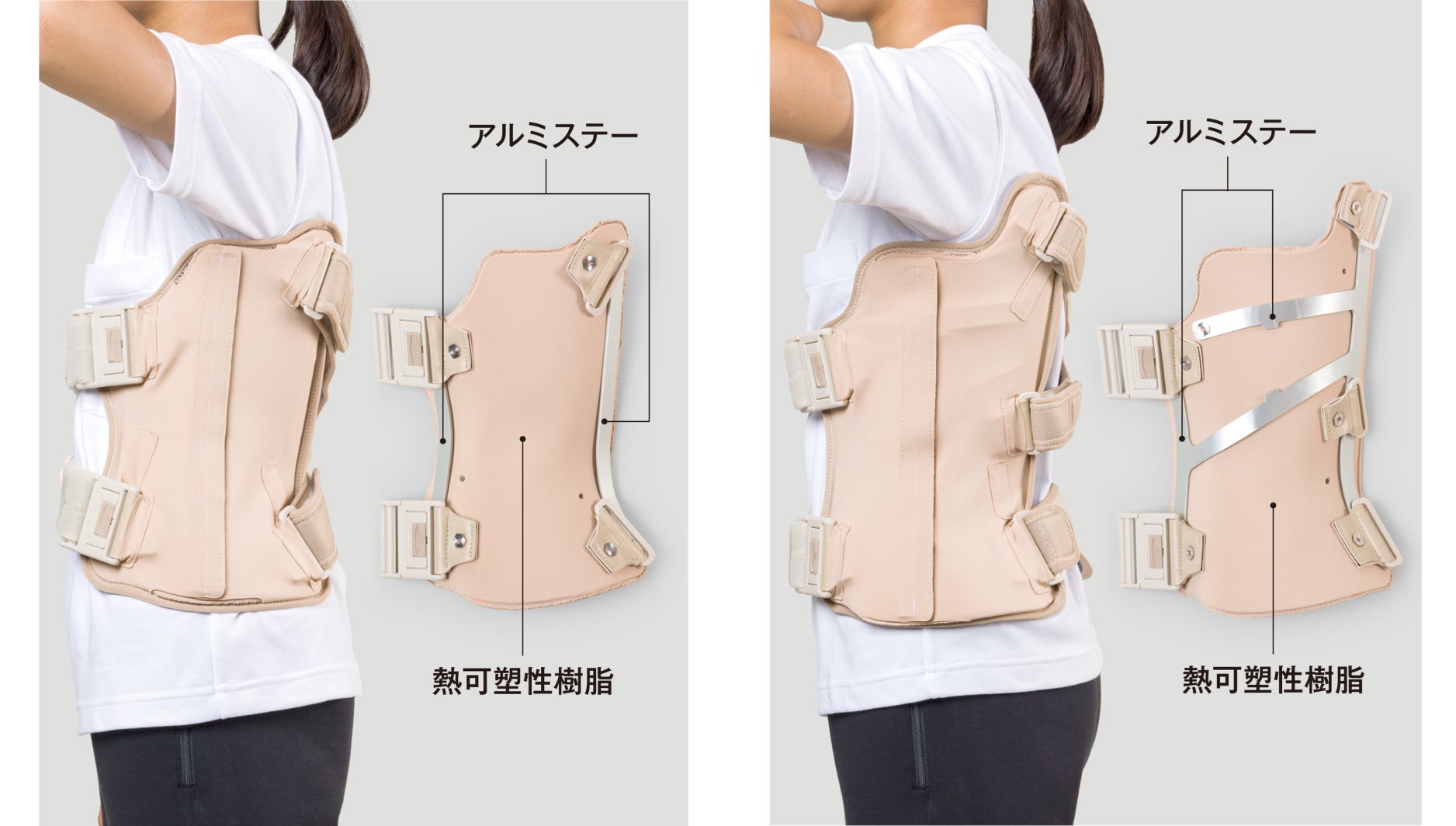 思春期特発性側弯症における装具装着の不快感を軽減 「脊柱の側方への