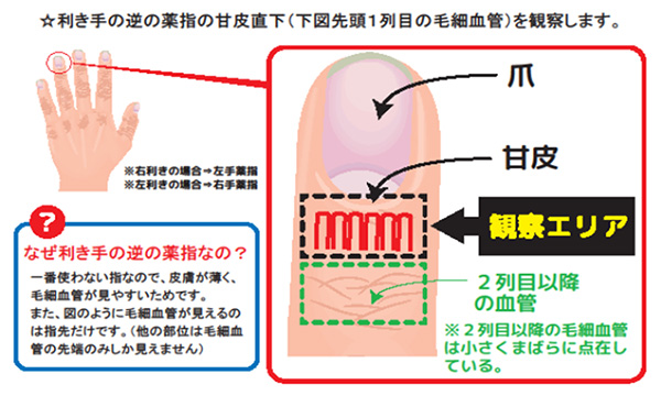 有用な毛細血管観察方法 | NPO法人 QOLサポート研究会
